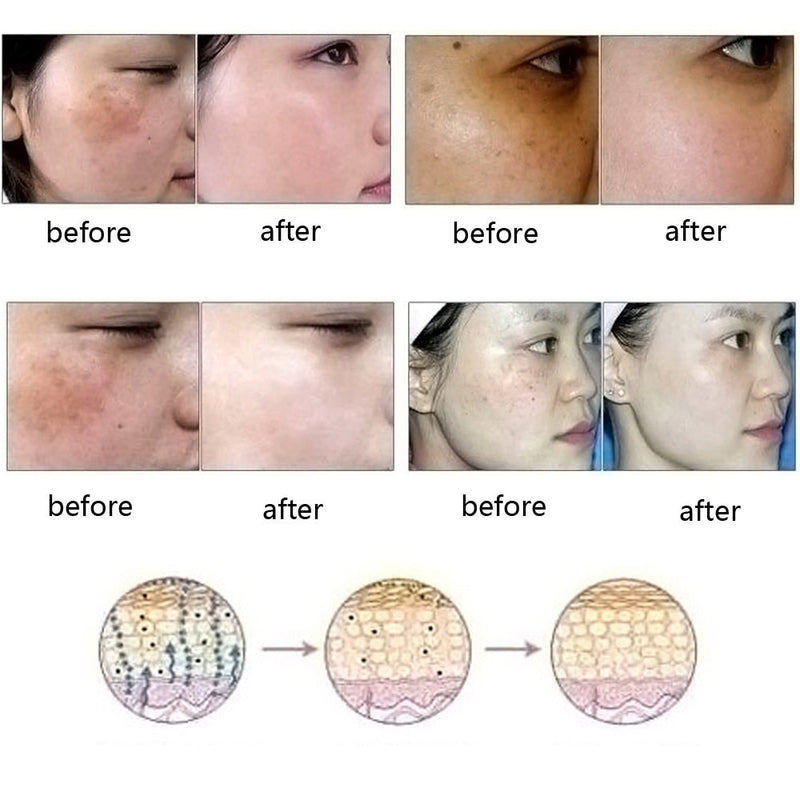 Dredge Meridian Skin Care Natural Pure Removal Acne Stretch Marks Scar Removal Essence oil Mostore.com