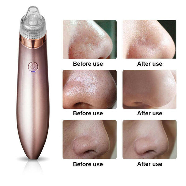 Electric Blackhead Vacuum Pore Cleaner Acne Pimple Remover Strong Suction Tool Electric Blackhead Remover Pore Vacuum Suction Diamond Dermabrasion Face Cleaner Mostore.com