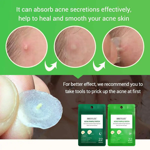 Tea Tree Acne Patch Fades Acne Marks and Ultra-thin Mostore.com